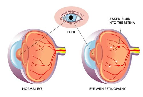 Image showing a diagram of an eye with normal vision and an eye with diabetic retinopathy